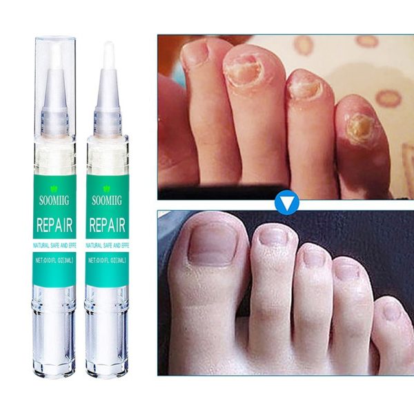 Stylo à ongles 3ML, traitement antifongique, Infection Paronychia, à base de plantes, pour orteils, accessoires de beauté, santé – Image 2