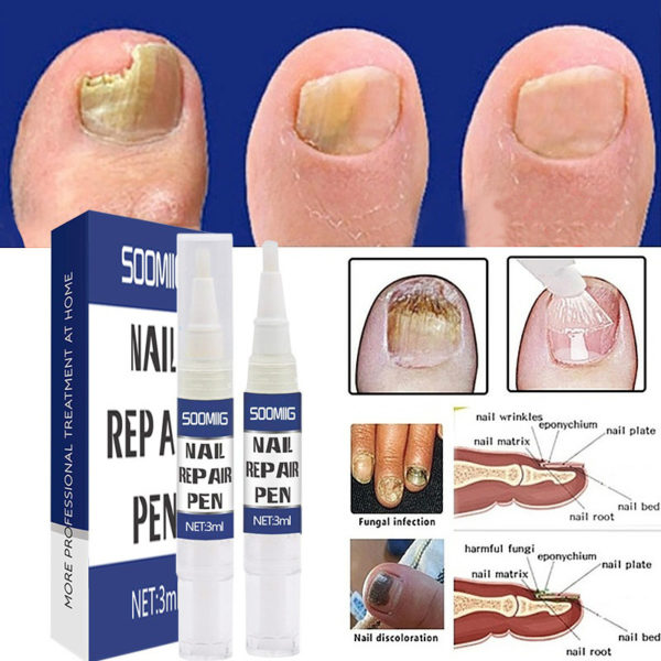 Stylo à ongles 3ML, traitement antifongique, Infection Paronychia, à base de plantes, pour orteils, accessoires de beauté, santé